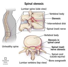 Spinal Fusion, Spinal Surgery, Types Of Surgery, Abdominal Surgery, Spine Health, Skeletal System, Spine Surgery, Pelvic Floor Exercises, Orthopedic Surgery