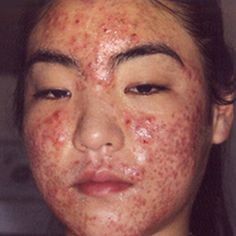 Severe acne Acne Remedy, Severe Acne Remedies, Acne Positivity, Treatments For Acne, Back Acne Remedies, Cystic Acne Remedies, Painful Acne, Back Acne