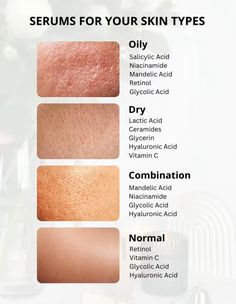 Skin Care Routine For Oily Skin, Oily Face Remedy, Acne Types, Serum For Oily Skin, Oily Skin Face, Beauty Treatments Skin Care, Mekap Mata, Skin Care Basics, Face Skin Care Routine