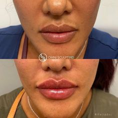 Lip Injection Before & After Gallery | OMNI SCULPT MD