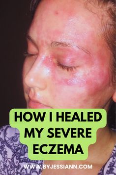 How I Healed My Severe Eczema - Excema Treatments DIY Healing Strategies, Itchy Skin Remedy, I Healed, Severe Dry Skin, Dry Skin Care, Itchy Skin, Natural Remedies, Health And Beauty