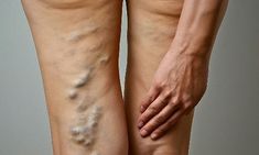 a woman's legs with varicous on them