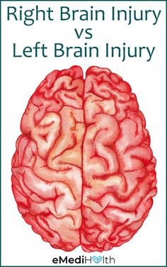 Brain Bleed Recovery, Lesions On Brain, Brain Surgery Humor, L Tyrosine Benefits, My Beautiful Broken Brain, Vitamin Sources, Brain Recovery, Traumatic Brain Injuries