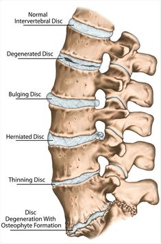 Spinal Degeneration, Lumbar Disc, Intervertebral Disc, Bulging Disc, Spinal Nerve, Spine Health, Human Skeleton