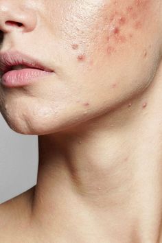 Explore cutting-edge acne treatments recommended by top dermatologists to finally achieve clear and radiant skin. Acne Photography, Acne Aesthetic, Acne Photos, Best Acne Scar Removal, Acne Remedy, Skin Pictures, Facial Services, Oily Skin Face, Back Acne