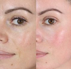 Before After Skincare, Lines Around Mouth, Bumps Under Eyes, Makeup Wall Art, Post Inflammatory Hyperpigmentation, Natural Anti Aging Skin Care, Face Peel, Before After Photo, Chemical Peel