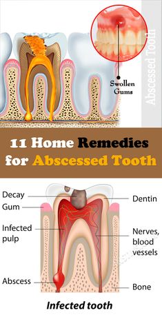 A tooth abscess that has appeared on the mucous membrane and skin can cause more serious ailments in other organs. After all, as a result of this inflammation, purulent foci are formed, which always harbor a significant danger. Abscess Tooth, Tooth Pain Remedies, Tooth Pain Relief, Teeth Remedies, Tooth Infection, Remedies For Tooth Ache, Swollen Gum, Tooth Pain, Teeth Health