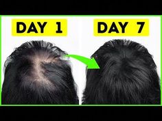 BEST HAIR GROWTH REMEDY TO GROW HAIR IN 1 WEEK || FIX HAIR FALL PROBLEM AND REGROW HAIR FAST-----------------------------------------------------------------... Bushy Hair, Hair Fall Problem, Get Thicker Hair, Hair Transplant Surgery, Hair Care Regimen, Homemade Hair Products