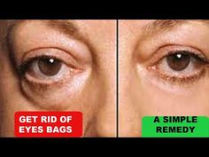 Baking Soda Under Eyes, Eye Bag Remedies, Eyes Wrinkles, Remove Eye Bags, Eyes Dark, Under Eye Wrinkles, Remove Dark Circles, Under Eyes, Well Well