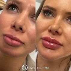 Lip Injection Before & After Gallery | OMNI SCULPT MD