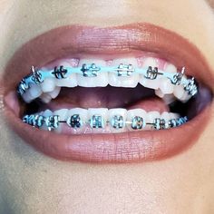 Power Chain Braces, Invisible Teeth Braces, Green Braces, Braces Rubber Bands, Power Chain