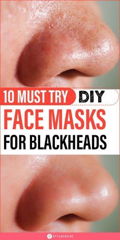 Face Masks For Blackheads, Masks For Blackheads, Removing Blackheads, For Blackheads, Face Mask For Blackheads, Black Head Remover Mask, Blackhead Mask, Black Heads, Natural Sleep Remedies