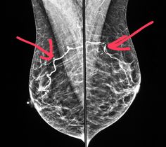 an x - ray image shows the breast with red arrows pointing to it's utensils