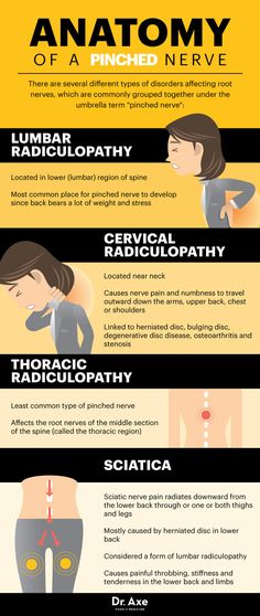 Anatomy of a pinched nerve - Dr. Axe #health #holistic #natural Pinched Nerve, Nerve Pain Relief, Knee Pain Relief, Vicks Vaporub