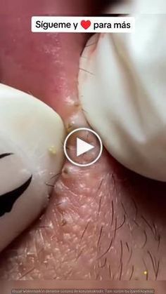 Pimples Around Lips, Big Blackheads Removal Satisfying Videos, Lip Blackheads, White Pimples On Face, Cystic Pimple Pop, Cysts Popping Videos, Acne Popping, Neck Pimples