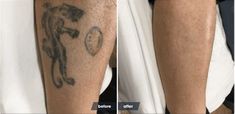 before and after photos of a man's legs with tattoos on his legs, showing the results of laser removal