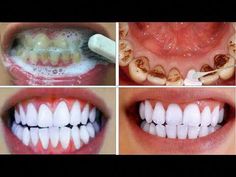 How to make your teeth white in 5 minutesIf you are looking for a natural way to whiten your teeth, you have come to the right place! This easy oral health t... Baking Soda Teeth, Teeth Whiting At Home, Baking Soda Teeth Whitening, Baking Soda Benefits, Baking Soda And Lemon, Diy Teething