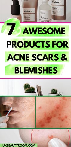 7 Best Products from The Ordinary for Acne Scars Acne Map, Face Map, Face Remedies, Acne Scar Remedies, Scar Remedies, Ordinary Niacinamide, Face Mapping Acne