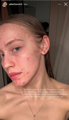 Acne Awareness, Acne Beauty, Pretty Body, Acne Skin, Acne, Skin Care, Skin, Makeup