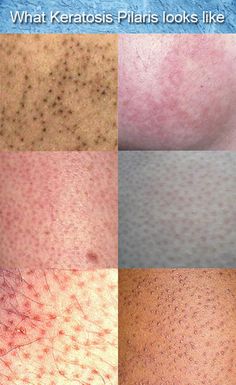 The good news is: Keratosis Pilaris is unnecessary, unsightly, and very easy to control!    Treatment includes smoothing away the bumps through exfoliation and hydration. This will eliminate the bumps and improve the overall appearance of your skin.    Treatment for Keratosis Pilaris needs to be continuous – if stopped, skin begins reforming around hair follicles. Ketosis Pilaris, Dermatology Nurse, Best Lotion, Healthy Skin Tips, Hair Follicles, Hair Growth Faster