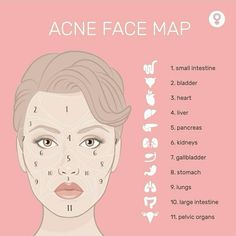 Acne Marks Remedies, Acne Face Map, Beauty Marks, Acne Face