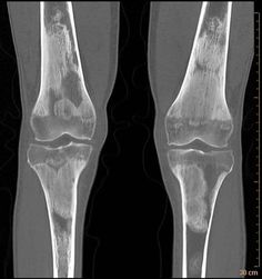 Skeletal involvement in Erdheim Chester Disease (a non-langerhan's cell histiocytosis) with classic appearance of symmetrical metaphyseal sclerosis and corresponding increased uptake on Tc-MDP bone scan. Langerhans Cell Histiocytosis, Langerhans Cell, Pagets Disease, Medical Imaging, Med Student