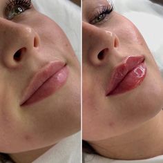 Lip Fillers Juvederm, Dream Lips, Photoshoot Tips, Graduation Frame, Text On Photo, Self Development