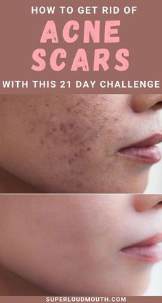 Annoying Things, Acne Overnight, Acne Dark Spots, Dark Spots On Face, Get Rid Of Acne, Rid Of Acne, Natural Face Skin Care, Natural Acne Remedies, Home Remedies For Acne