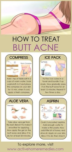 Forehead Acne, Skin Care Basics, Diy Skin Care Routine, Good Skin Tips, Natural Acne, Skin Care Diy, Perfect Skin Care Routine, Acne Remedies