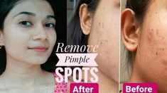 How to Remove Pimple and Pimple Spots Naturally at Home|Get Clean and Glowy skin|Style with Rakhi Skin Hacks, Prevent Pimples