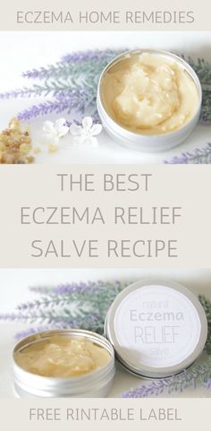 Home Remedies for Eczema with My Favorite Eczema Salve Recipe #essentialoilsforeczema #homeremediesforeczema #howtogetridofeczemabaturally #diyeczemacream Cooking With Turmeric, Salve Recipes, Natural Healing Remedies, Diy Remedies, Cold Home Remedies, Pose Yoga, Natural Therapy, Natural Health Remedies, Natural Home Remedies