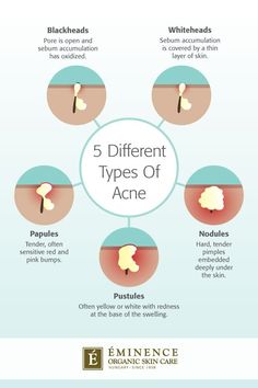 Types Of Acne: The Differences Between Your Bumps And Blemishes | Eminence Organic Skin Care Types Of Acne And How To Treat, Skincare Esthetics, Cosmetology Aesthetic, Face Remedies, Face Gym, Types Of Facials, Eminence Organic Skin Care