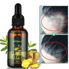 ALL SMART DEALS Aceite Tratamiento Para La Caidad Del Pelo Cabello Calvicie Anticaida Capilar Crecimiento capilar Aceites esenciales Jengibre Aceite germinal Crecimiento capilar rápido Pérdida anticaída Tratamiento de alopecia Suero de crecimiento capilar denso en belleza Especificaciones: Nombre: aceite de crecimiento de cabello de jengibre Contenido neto: 30 ml Ingredientes:  jengibre, ginseng, festival loca, raíz de flor de vellón, aceite de semilla de uva.   Caracteristicas: * El a Regrow Ginger, Ginger Hair Growth, Essential Oil Hair Growth, Hair Growth Secrets, Fast Hair, Ginger Essential Oil, Regrow Hair, Hair Growth Serum, Hair Growth Faster