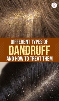 Oils For Dandruff, Getting Rid Of Dandruff, How To Grow Your Hair Faster, Natural Acne Remedies, Baking Soda Shampoo, How To Grow Nails, Flexible Dieting, Long Hai