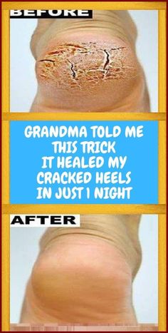 GRANDMA TOLD ME THIS TRICK. IT HEALED MY CRACKED HEELS IN JUST 1 NIGHT!!! Cracked Heels, 1st Night, Health Habits, Healthy Lifestyle Tips, Lose 50 Pounds, Health And Fitness Tips, Health Facts, Alternative Medicine, Health Remedies