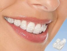 Ceramic Braces, Dental Posters, Dental Website, Clear Braces, Beautiful Teeth, Dental Marketing, Dental Braces, Orthodontics Braces