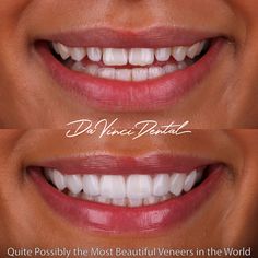 New Movie Posters, Dental Problems, Before Baby, Quotes And Notes, Cosmetic Dentistry, Tooth Decay, Healthy Teeth, Dental Clinic