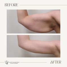 Arm Lift Surgery, Skin Removal Surgery, Smart Lipo, Body Massage Techniques, Pretty Nose, Arm Lift, Extra Skin, After Surgery