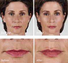 https://flic.kr/p/21RCcmd | Volbella Lip Filler | Volbella Lip Filler Dr. John L. Burns, Jr., MD Board Certified Plastic Surgeon President, Dallas Plastic Surgery Institute Lip Scrub Recipe, Exfoliating Lip Scrub, Homemade Lip Balm, Facial Wrinkles, Facial Rejuvenation, Lip Contouring