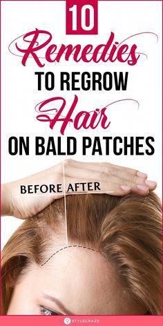 #NaturalHelpForHairLoss Hair Care Remedies, Bald Patches, Home Remedies For Hair, Regrow Hair, Lost Hair, Hair Remedies, Hair Regrowth, Hair Care Tips, Hair Health