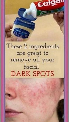 Vaseline Uses For Face, Eye Wrinkles Remedies, Glowing Skin Overnight, Wrinkles Remedies Face, Vaseline Uses, Brown Spots On Skin, Wrinkle Remedies