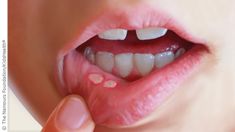 Canker Sore Home Remedies, Ulcer Remedies Mouth, Canker Sore Remedy, Canker Sore, Jairzinho, Natural Home Remedies, Homeopathy, Home Health