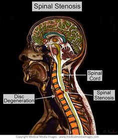 Numbness In Fingers, Arm Numbness, Spinal Degeneration, Vertigo Causes, Upper Cervical Chiropractic, Cervical Disc, Spinal Surgery