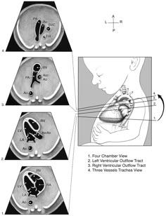 the diagram shows different stages of heart valves