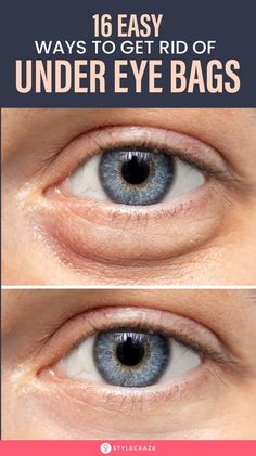 Undereye Bags Remedy, Get Rid Of Eye Bags, Rid Of Eye Bags, Eye Bag Remedies, Puffy Eyes Remedy, Lifting Facial, Remove Dark Circles, Skin Care Wrinkles, Dark Circles Under Eyes