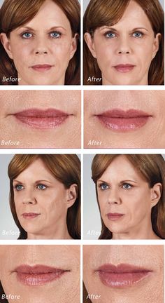 https://flic.kr/p/DQnZfy | Volbella Lip Filler | Volbella Lip Filler Dr. John L. Burns, Jr., MD Board Certified Plastic Surgeon President, Dallas Plastic Surgery Institute Volbella Lips Before And After, Botox Before And After, Cosmetic Procedures, The Good Life