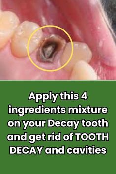 Decayed Tooth, Home Gum, Baking Soda Teeth Whitening, Teeth Remedies, Tooth Decay Remedies, Tooth Repair, Heal Cavities, Healthy Gums, Teeth Health