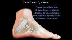 Tarsal Tunnel Syndrome - Everything You Need To Know - Dr. Nabil Ebraheim Tibial Nerve, Tarsal Tunnel, Ankle Anatomy, Muscular Anatomy, Toenail Care, Anti Aging Body, Muscle Anatomy, Surgery Recovery