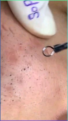 Dive into the oddly mesmerizing world of pimple popping, where every squeeze brings a sense of relief and satisfaction. From blackheads to cysts, discover the most satisfying extractions and techniques to indulge in the guilty pleasure of skincare enthusiasts everywhere. Skin Care Extractors, Wedding Skincare, Minimalist Skincare, Blackhead Mask, The Guilty, Winter Skin Care, Most Satisfying, Guilty Pleasure, Guilty Pleasures