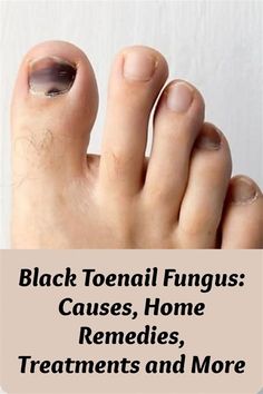 How To Get Rid Of Black Nail Fungus. There are any references about How To Get Rid Of Black Nail Fungus in here. you can look below. I hope this article about How To Get Rid Of Black Nail Fungus can be useful for you. Please remember that this article is for reference purposes only. #how #to #get #rid #of #black #nail #fungus Black Spot On Toenail, Black Toenail Fungus, Toenail Health, Black Toe Nails, Tongue Health, Health Signs, Toenail Fungus, Striped Nails, Black Nail